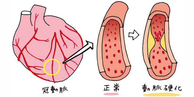 《インド》肥満税で生活習慣病を予防!? ジャンクフード好きは要注意!