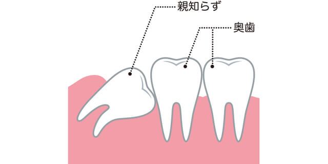 親知らずで口内炎に…意外と知らない親知らずが与える口内への悪影響とは