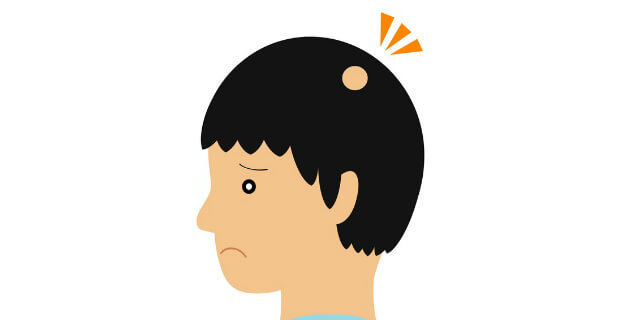 毛が抜けた部分がある男性