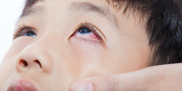 【眼科医が教える】目薬を嫌がる子どもに上手にさす方法