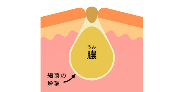 子どもの耳の周りに謎の小さな穴が…「耳瘻孔」の原因と治療法とは?
