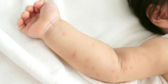 手足口病の子ども