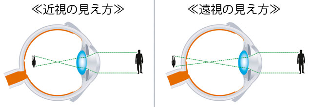 コンタクトレンズとメガネの見え方の違いってどうして?